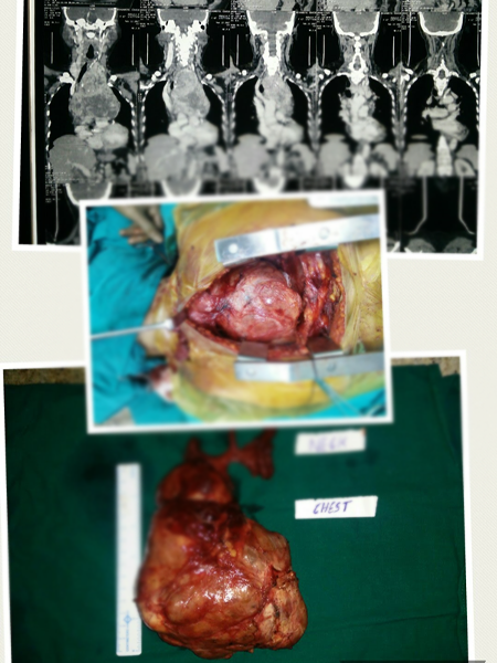 Thyroid Surgery in Hyderabad